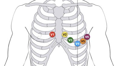 leads ecg placement