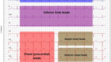leads for ekg